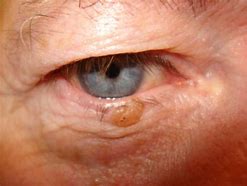 Image result for Verrucous Wart Eyelid