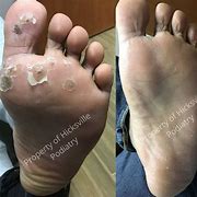 Image result for Plantars Warts Treatments On Foot