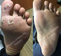 Image result for Plantar Wart Removal Surgery