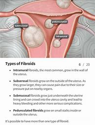 Image result for 10 Cm Uterine Fibroid