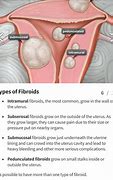 Image result for Polypoidal Uterine Fibroid