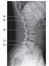 Image result for infervertebral