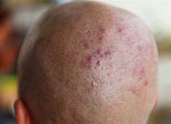 Image result for Pimples On Head Scalp