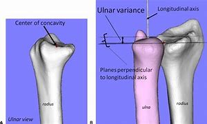 Image result for Fovea Inferior Angle Oris