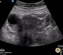 Image result for Ovarian Dermoid Cyst 10Cm