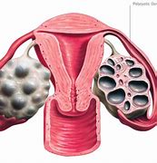 Image result for Polycystic Ovary