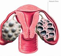 Image result for Polycystic Ovary Syndrome