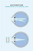 Image result for Contacts Astigmatism Alignment Marker