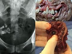 Image result for teratoma