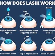 Image result for LASIK Eye