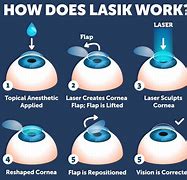 Image result for After Lasik Eye Surgery