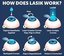 Image result for Lasik Treatment
