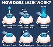 Image result for Lasik Eye Surgery Procedure