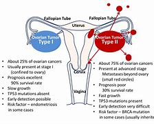 Image result for Ovarian Carcinosarcoma