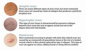Image result for Different Acne Scars
