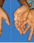 Image result for Palmar Wart Removal