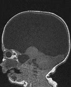 Image result for Hydranencephaly MRI Radiopaedia