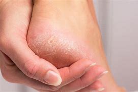 Image result for Calluses On Bottom of Feet