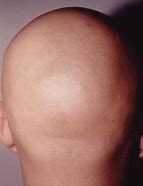 Image result for alopefia