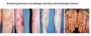 Image result for choroba_leśniowskiego crohna