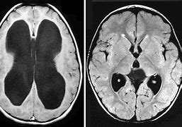 Image result for Hydrocephalus