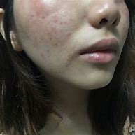 Image result for Itchy Burning Bumps On Skin