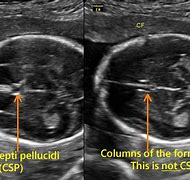 Image result for CSP Fetal Ultrasound