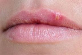 Image result for Allergic Reaction Swollen Upper Lip