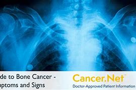 Image result for Collar Bone Cancer Symptoms
