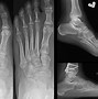 Image result for 4th Metatarsal Fracture