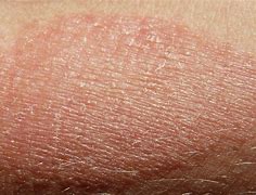 Image result for Nickel Eczema