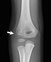 Image result for Condyle of Humerus