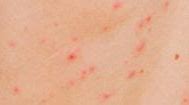 Image result for Chickenpox