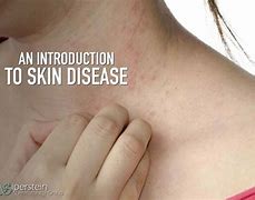 Image result for Holely Skin Deaease