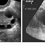 Image result for Ovarian Functional Cyst vs Septated Cyst On Ultrasound