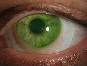 Image result for Scleral Contact Lenses Keratoconus