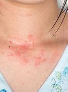 Image result for Allergic Skin Rash On Face