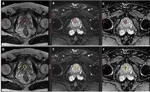 Image result for 9Mm Tumor On Prsotate