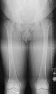 Image result for Hto Osteotomy