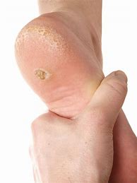 Image result for Planters Wart On Toe