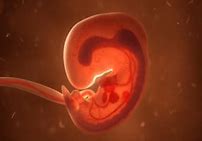 Image result for Anencephaly