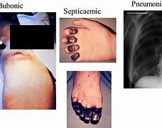 Image result for Yersinia Pestis Infection