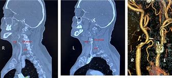 Image result for Bilateral Carotid Artery Stenting