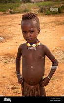 Image result for Distended Belly of Child