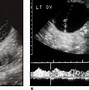 Image result for Hemorrhagic Ovarian Cyst Ultrasound