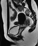 Image result for Left Adnexal Cyst
