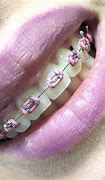 Image result for Braces Colors Pink