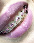 Image result for Black and Pink Braces