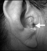 Image result for Ear Canal Wart