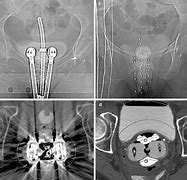 Image result for Brachytherapy Cervical Cancer